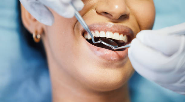 Best Knocked-Out Tooth (Avulsed Tooth) Treatment in Smyrna, DE